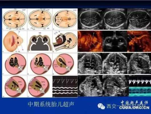 胎儿左心室有强光斑是什么意思啊?B超单是这样写的,胎儿左心室强光斑多久会消失 第2张 胎儿左心室有强光斑是什么意思啊?B超单是这样写的,胎儿左心室强光斑多久会消失 第2张
