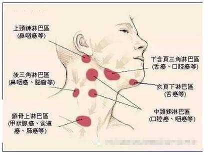 淋巴结肿大是怎么回事,淋巴结肿大的原因有哪些,怀孕期间淋巴结肿大怎么办 第3张 淋巴结肿大是怎么回事,淋巴结肿大的原因有哪些,怀孕期间淋巴结肿大怎么办 第3张
