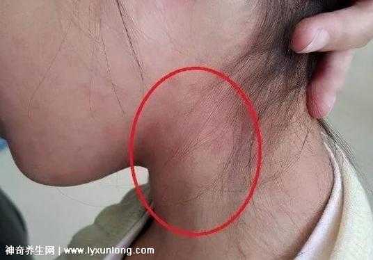 淋巴结肿大是怎么回事,淋巴结肿大的原因有哪些,怀孕期间淋巴结肿大怎么办 第2张 淋巴结肿大是怎么回事,淋巴结肿大的原因有哪些,怀孕期间淋巴结肿大怎么办 第2张