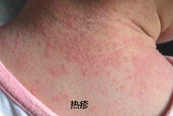 孕妇得了湿疹怎么办,孕期吃新生儿湿疹怎么办啊 第2张 孕妇得了湿疹怎么办,孕期吃新生儿湿疹怎么办啊 第2张