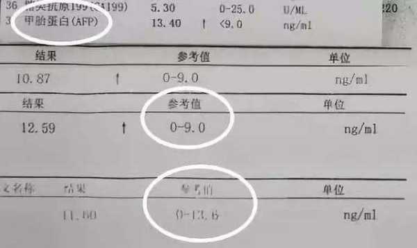 甲胎蛋白多少是肝癌,孕期甲胎蛋白正常值是多少? 第1张 甲胎蛋白多少是肝癌,孕期甲胎蛋白正常值是多少? 第1张