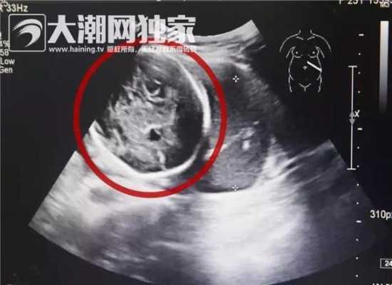 怀孕六个月胎儿趴着是什么原因,6个半月的胎儿图片大全  第3张