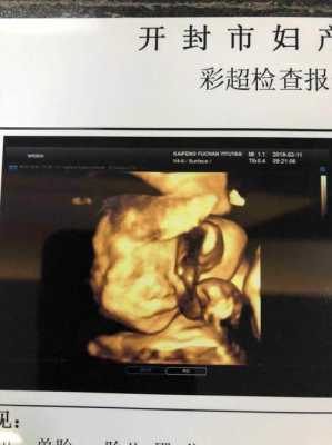 怀孕23周胎儿彩超图(怀孕23周胎儿彩超图片) 第2张 怀孕23周胎儿彩超图(怀孕23周胎儿彩超图片) 第2张