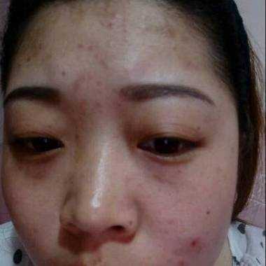 怀孕期间脸上长痘痘是怎么回事(怀孕期间脸上长痘痘是怎么回事啊) 第2张 怀孕期间脸上长痘痘是怎么回事(怀孕期间脸上长痘痘是怎么回事啊) 第2张