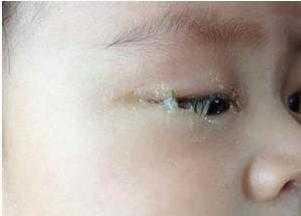孕妇5个月胎儿图片(5个月宝宝眼睛眼屎多) 第1张 孕妇5个月胎儿图片(5个月宝宝眼睛眼屎多) 第1张