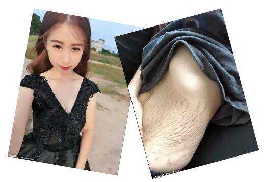 妊娠纹是什么?妊娠纹怎么消除,孕期泳装身材变化记录视频 第2张 妊娠纹是什么?妊娠纹怎么消除,孕期泳装身材变化记录视频 第2张