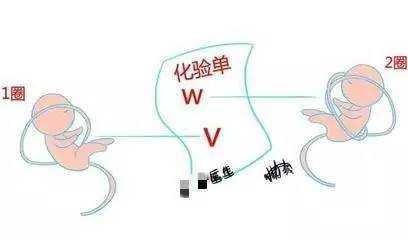 胎儿有u型压迹怎么纠正(胎儿有u型压迹怎么调整) 第2张 胎儿有u型压迹怎么纠正(胎儿有u型压迹怎么调整) 第2张