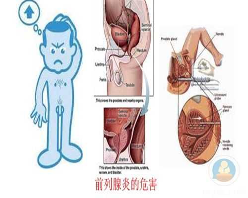 前列腺炎对胎儿有影响吗,前列腺炎会影响胎儿吗 第1张 前列腺炎对胎儿有影响吗,前列腺炎会影响胎儿吗 第1张