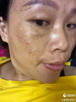 怀孕长斑怎么回事,孕期长雀斑生完会退吗 第1张 怀孕长斑怎么回事,孕期长雀斑生完会退吗 第1张