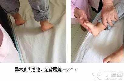 孕期按脚(孕期按脚会导致小孩脑瘫吗) 第3张 孕期按脚(孕期按脚会导致小孩脑瘫吗) 第3张