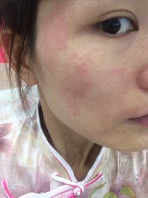孕期面部皮炎(孕期面部皮炎) 第1张 孕期面部皮炎(孕期面部皮炎) 第1张