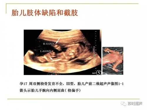 胎儿肢体小(胎儿肢体小于孕周) 第1张 胎儿肢体小(胎儿肢体小于孕周) 第1张