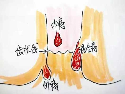 孕妇痔疮出来了要怎么办好,孕期内痔疮大便出血怎么办 第2张 孕妇痔疮出来了要怎么办好,孕期内痔疮大便出血怎么办 第2张