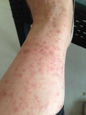 孕妇为什么会得湿疹,孕期湿疹原因有哪些  第2张