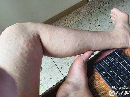 孕妇为什么会得湿疹,孕期湿疹原因有哪些  第3张