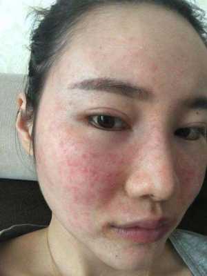 脸部色素沉着怎么办,孕期色素沉着怎么办  第2张