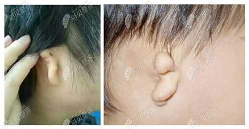 宝宝耳朵轮廓不适特别圆滑是怎么回事,胎儿耳廓图片  第3张