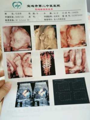 四维彩超显示胎儿的鼻子眼睛都是歪的,会不会是畸形,胎儿眼睛畸形是原因造成的 第2张 四维彩超显示胎儿的鼻子眼睛都是歪的,会不会是畸形,胎儿眼睛畸形是原因造成的 第2张