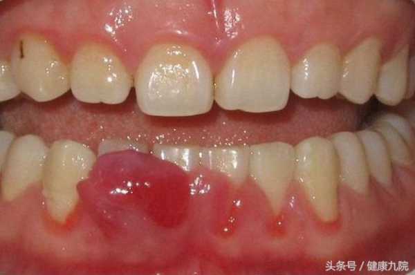孕期牙根发炎(孕期牙根发炎要痛几天) 第1张 孕期牙根发炎(孕期牙根发炎要痛几天) 第1张