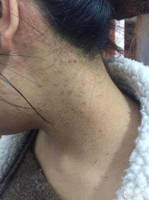 怀孕了能挤痘痘吗,孕期挤痘痘会影响胎儿发育吗 第3张 怀孕了能挤痘痘吗,孕期挤痘痘会影响胎儿发育吗 第3张