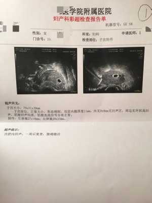 妊娠空囊是怎么回事,胎儿是空囊是什么意思 第1张 妊娠空囊是怎么回事,胎儿是空囊是什么意思 第1张