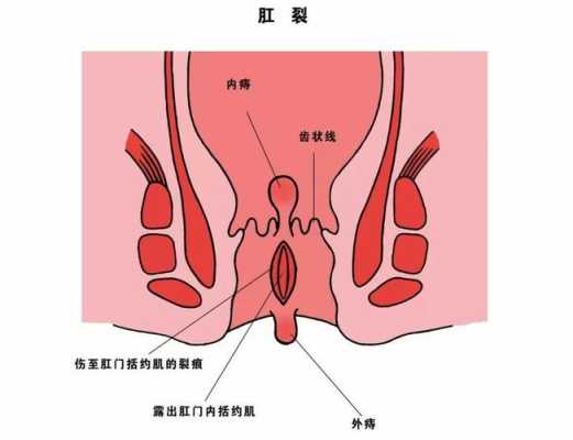 孕期痔疮肛裂(孕期痔疮肛裂) 第2张 孕期痔疮肛裂(孕期痔疮肛裂) 第2张