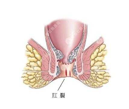 孕期痔疮肛裂(孕期痔疮肛裂) 第1张 孕期痔疮肛裂(孕期痔疮肛裂) 第1张