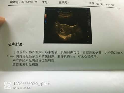 怀孕7周胚芽大小标准值是多少的,胎儿周图片 第3张 怀孕7周胚芽大小标准值是多少的,胎儿周图片 第3张