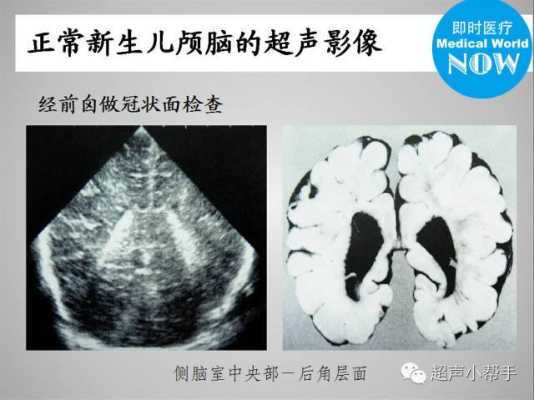 胎儿彩超头部(新生儿头颅彩超能检查出什么病) 第1张 胎儿彩超头部(新生儿头颅彩超能检查出什么病) 第1张