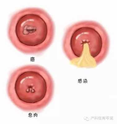 孕期阴道充血 第1张 孕期阴道充血 第1张
