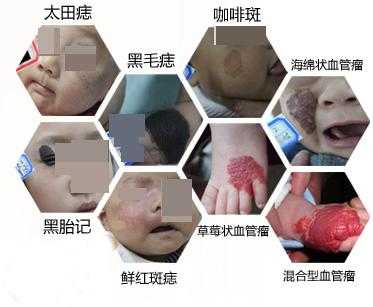 胎儿胎记是什么原因造成,胎儿长胎记的原因有哪些呢? 第1张 胎儿胎记是什么原因造成,胎儿长胎记的原因有哪些呢? 第1张