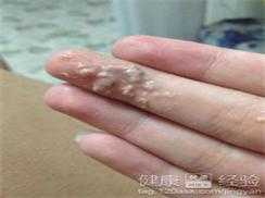 孕期白带豆渣(孕期白色豆渣分泌物多) 第1张 孕期白带豆渣(孕期白色豆渣分泌物多) 第1张