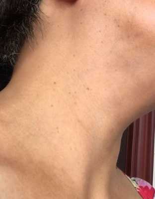 胎儿颈部皮肤增厚(胎儿颈部皮肤增厚是什么意思) 第1张 胎儿颈部皮肤增厚(胎儿颈部皮肤增厚是什么意思) 第1张