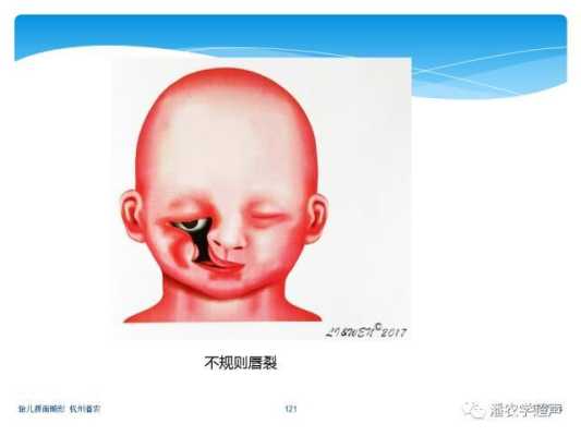 胎儿唇腭裂的原因（胎儿唇腭裂的原因跟男方有关吗）  第2张