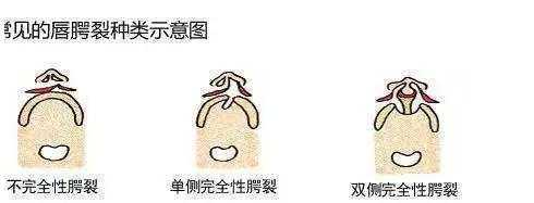 胎儿唇腭裂的原因（胎儿唇腭裂的原因跟男方有关吗）  第1张