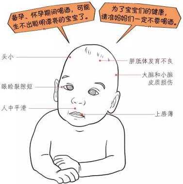 胎儿乙醇综合征（胎儿乙醇综合征）  第2张