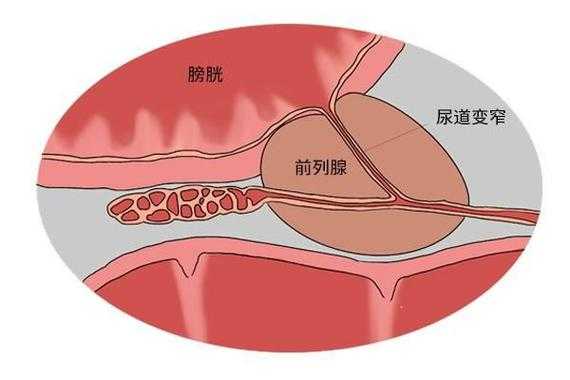 尿热是什么原因,孕期小便热是怎么回事 第3张 尿热是什么原因,孕期小便热是怎么回事 第3张