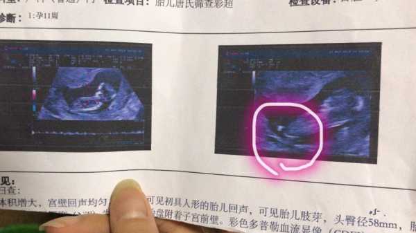 孕14周,胎儿NT厚约0.3cm是什么,怀孕14周胎儿彩超图片 第1张 孕14周,胎儿NT厚约0.3cm是什么,怀孕14周胎儿彩超图片 第1张