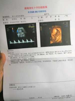 孕14周,胎儿NT厚约0.3cm是什么,怀孕14周胎儿彩超图片 第2张 孕14周,胎儿NT厚约0.3cm是什么,怀孕14周胎儿彩超图片 第2张