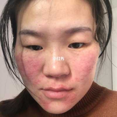 孕期脸好干(孕期脸好干会影响胎儿吗) 第1张 孕期脸好干(孕期脸好干会影响胎儿吗) 第1张