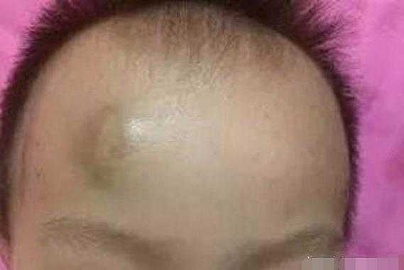 胎儿头皮水肿什么原因(宝宝头碰了个包怎么消肿) 第2张 胎儿头皮水肿什么原因(宝宝头碰了个包怎么消肿) 第2张