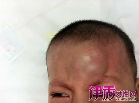 胎儿头皮水肿什么原因(宝宝头碰了个包怎么消肿) 第1张 胎儿头皮水肿什么原因(宝宝头碰了个包怎么消肿) 第1张