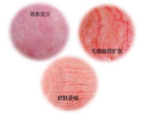孕期用了激素药膏(皮肤病用激素药的后果是什么) 第1张 孕期用了激素药膏(皮肤病用激素药的后果是什么) 第1张
