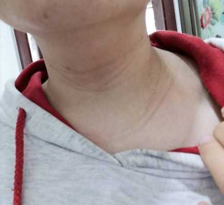 孕期脖子长纹(脖子上一条条纹路是什么) 第3张 孕期脖子长纹(脖子上一条条纹路是什么) 第3张