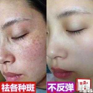 孕期如何淡斑（孕期如何淡斑去黄）  第2张