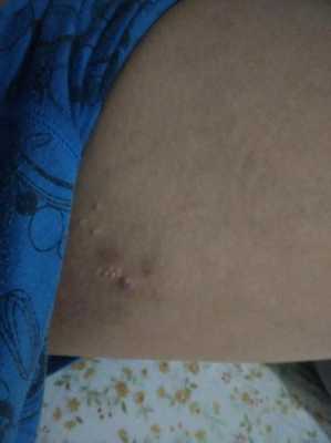 孕晚期大腿内侧长湿疹的很痒怎么治疗,孕期腿上长癣怎么办 第2张 孕晚期大腿内侧长湿疹的很痒怎么治疗,孕期腿上长癣怎么办 第2张