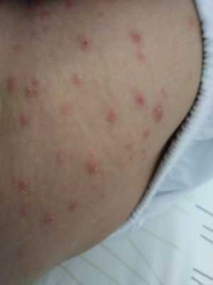孕晚期大腿内侧长湿疹的很痒怎么治疗,孕期腿上长癣怎么办 第1张 孕晚期大腿内侧长湿疹的很痒怎么治疗,孕期腿上长癣怎么办 第1张