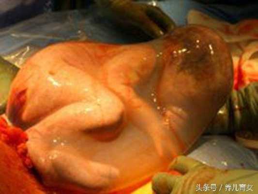 孕妇羊水脏影响胎儿是什么,羊水没了胎儿会怎么样呢 第1张 孕妇羊水脏影响胎儿是什么,羊水没了胎儿会怎么样呢 第1张