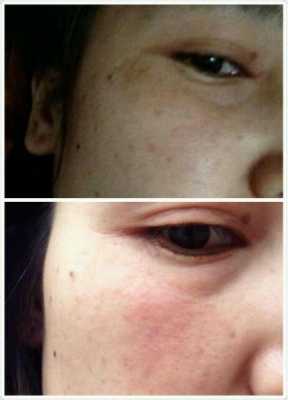 孕期长色斑(妊娠斑是怎么引起的) 第3张 孕期长色斑(妊娠斑是怎么引起的) 第3张