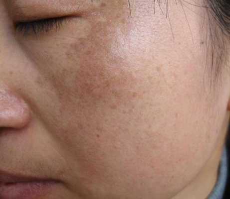 孕期长色斑(妊娠斑是怎么引起的) 第2张 孕期长色斑(妊娠斑是怎么引起的) 第2张